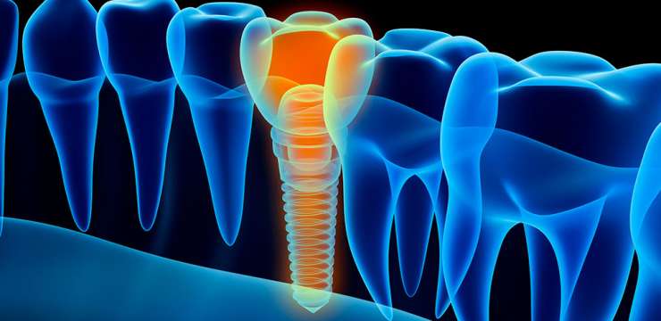What You Need To Know About Dental Implant Procedure