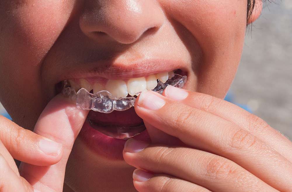 How Does Invisalign Work to Straighten Your Smile?