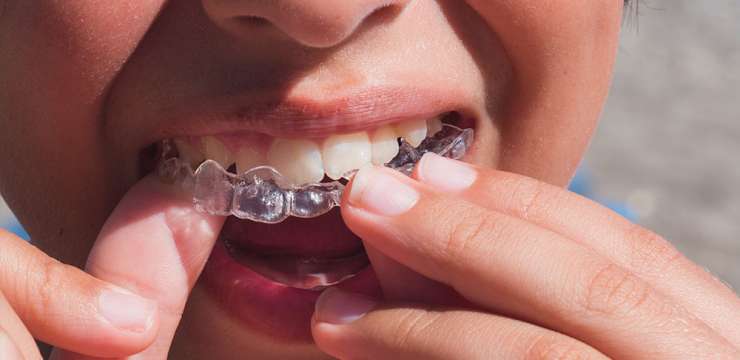 How Does Invisalign Work to Straighten Your Smile?